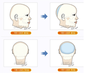 Illustration for article titled "Round Head" Plastic Surgery Seems Excessive, Even for South Korea